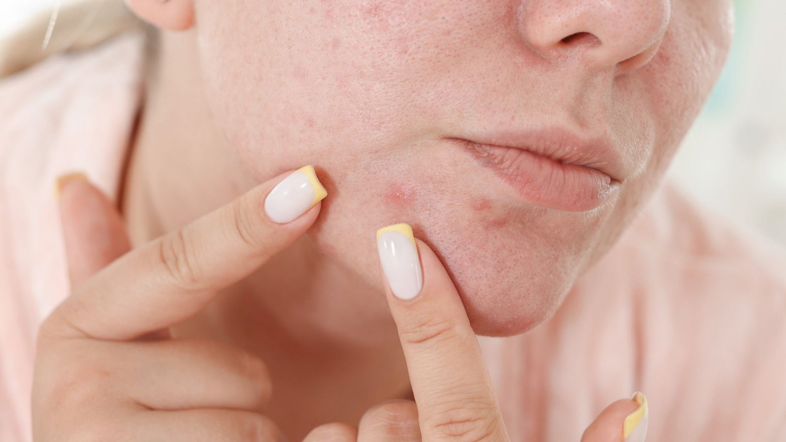 Acne Scar Treatment in Chennai | Virtue Wellness Clinic