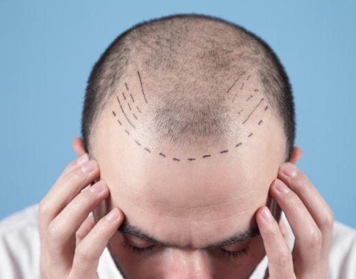 Cost for Hair Transplant in chennai 2026: Price & Factors