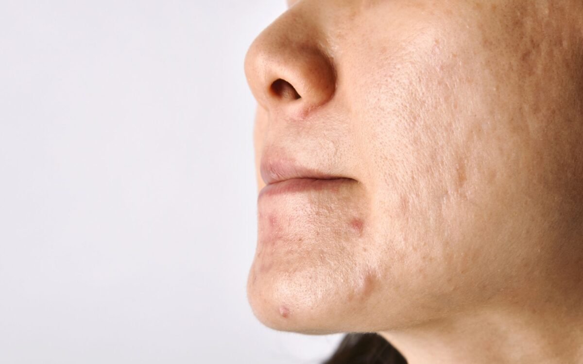 Micro Pigmentation: What It Is, Benefits, Procedure, Cost & Results