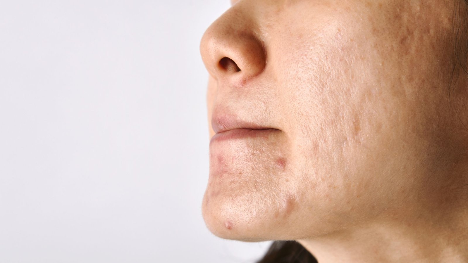 Micro Pigmentation: What It Is, Benefits, Procedure, Cost & Results