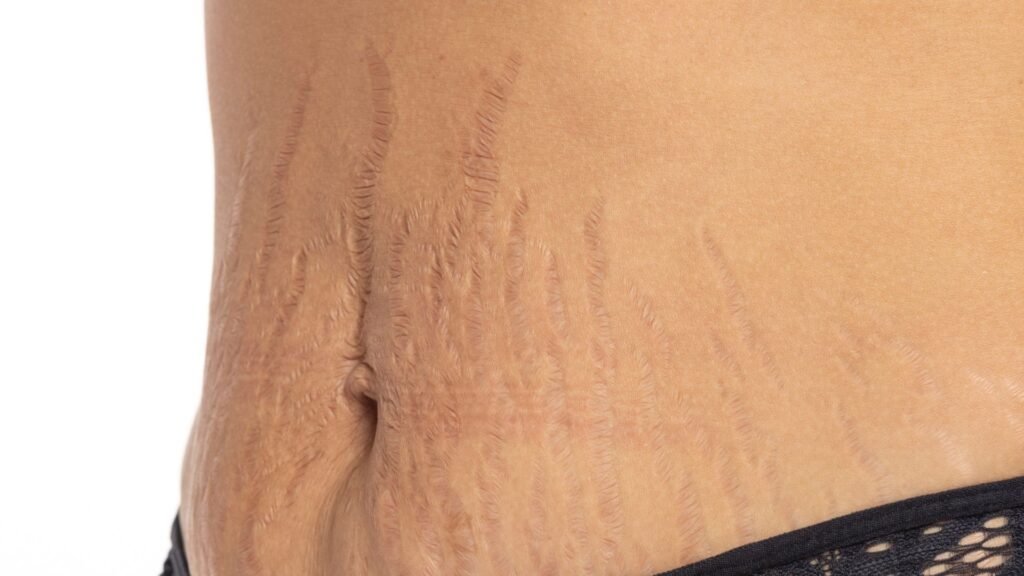 Stretch Mark Revision