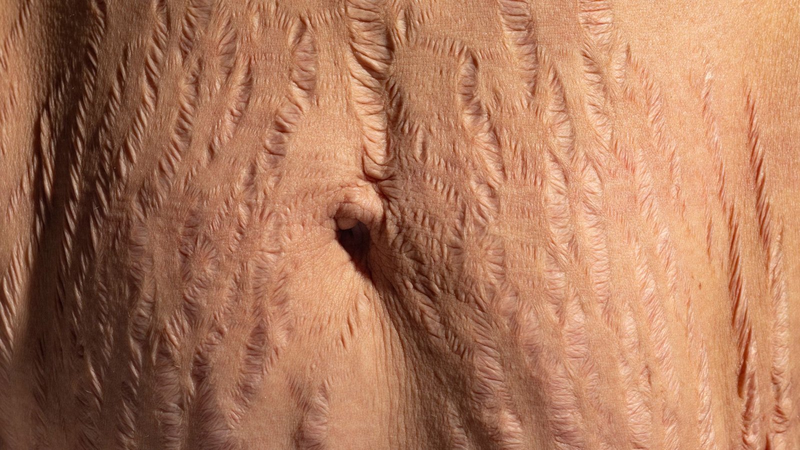 Stretch Mark Removal: How Treatments Work, Results & What to Expect