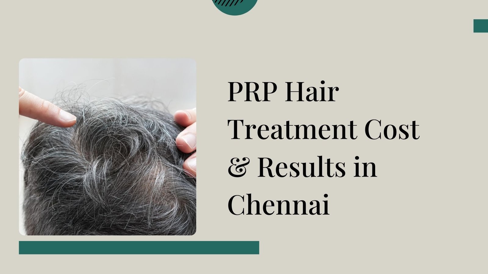 PRP Hair Treatment Cost in Chennai – Price & Results