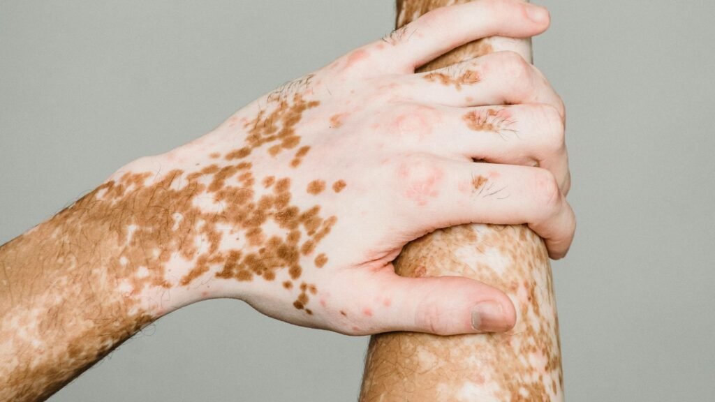 Vitiligo Treatment in Ambattur